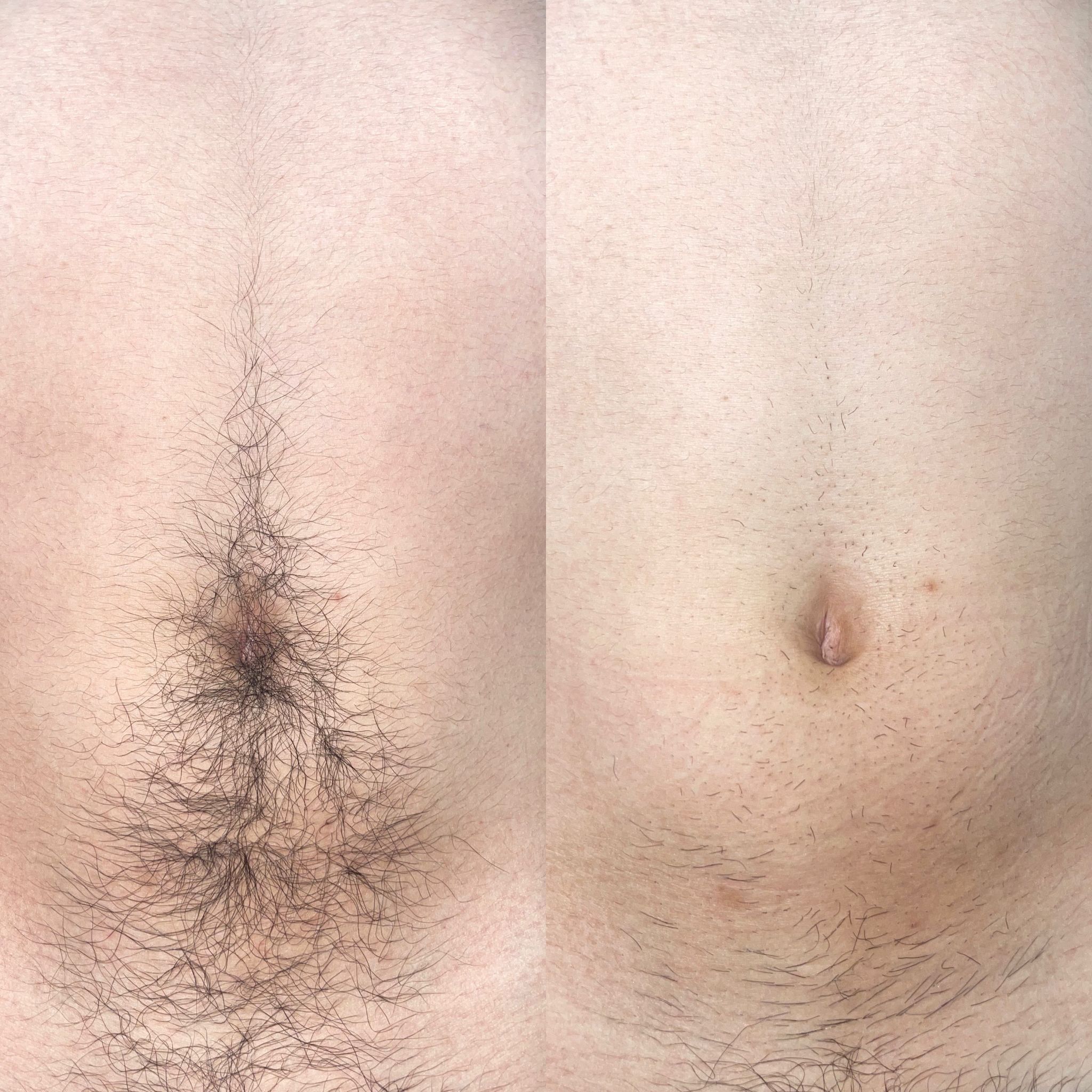 VIO施術、介護脱毛も承れますの画像