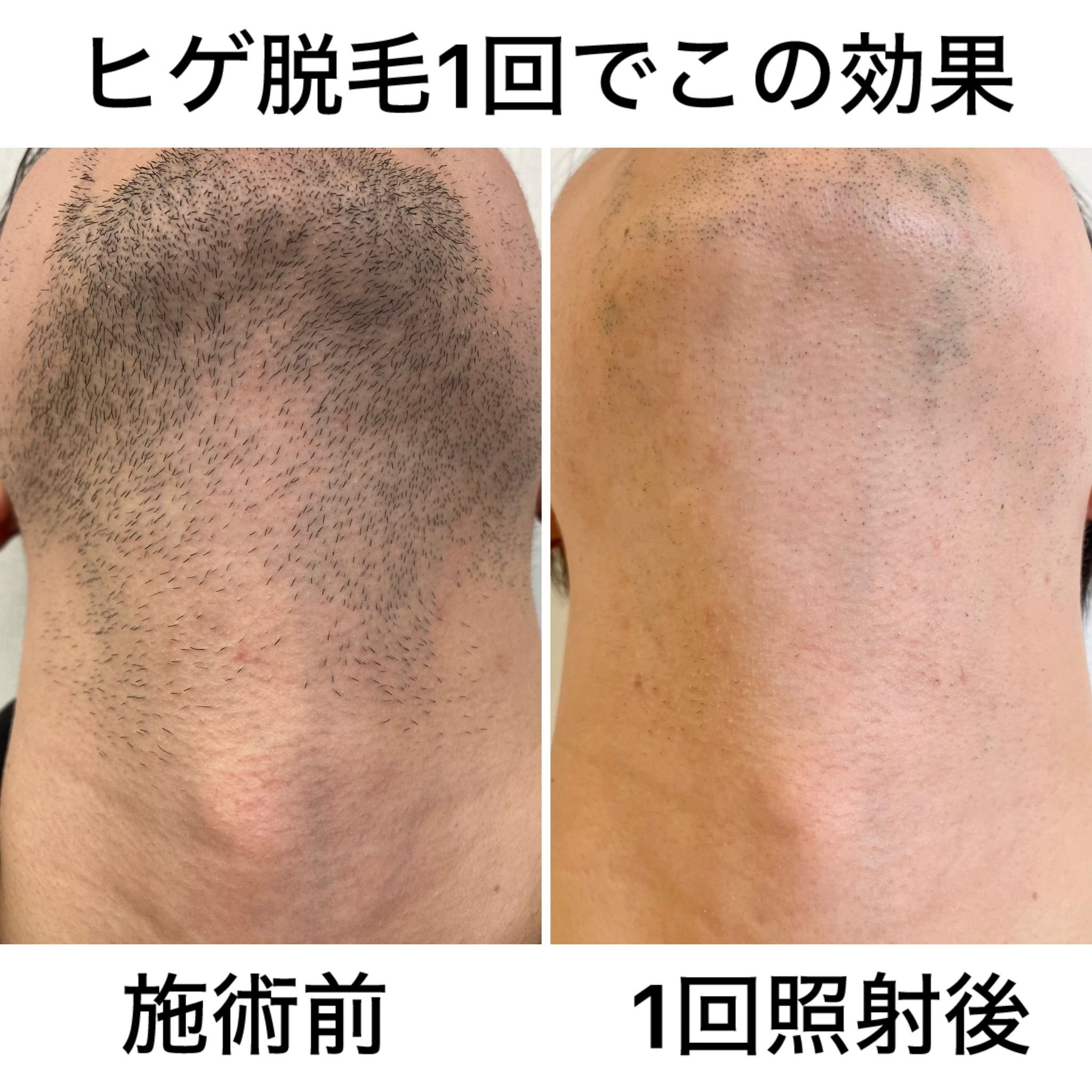 濃いヒゲ、青ヒゲ、身だしなみ清潔に♪の画像