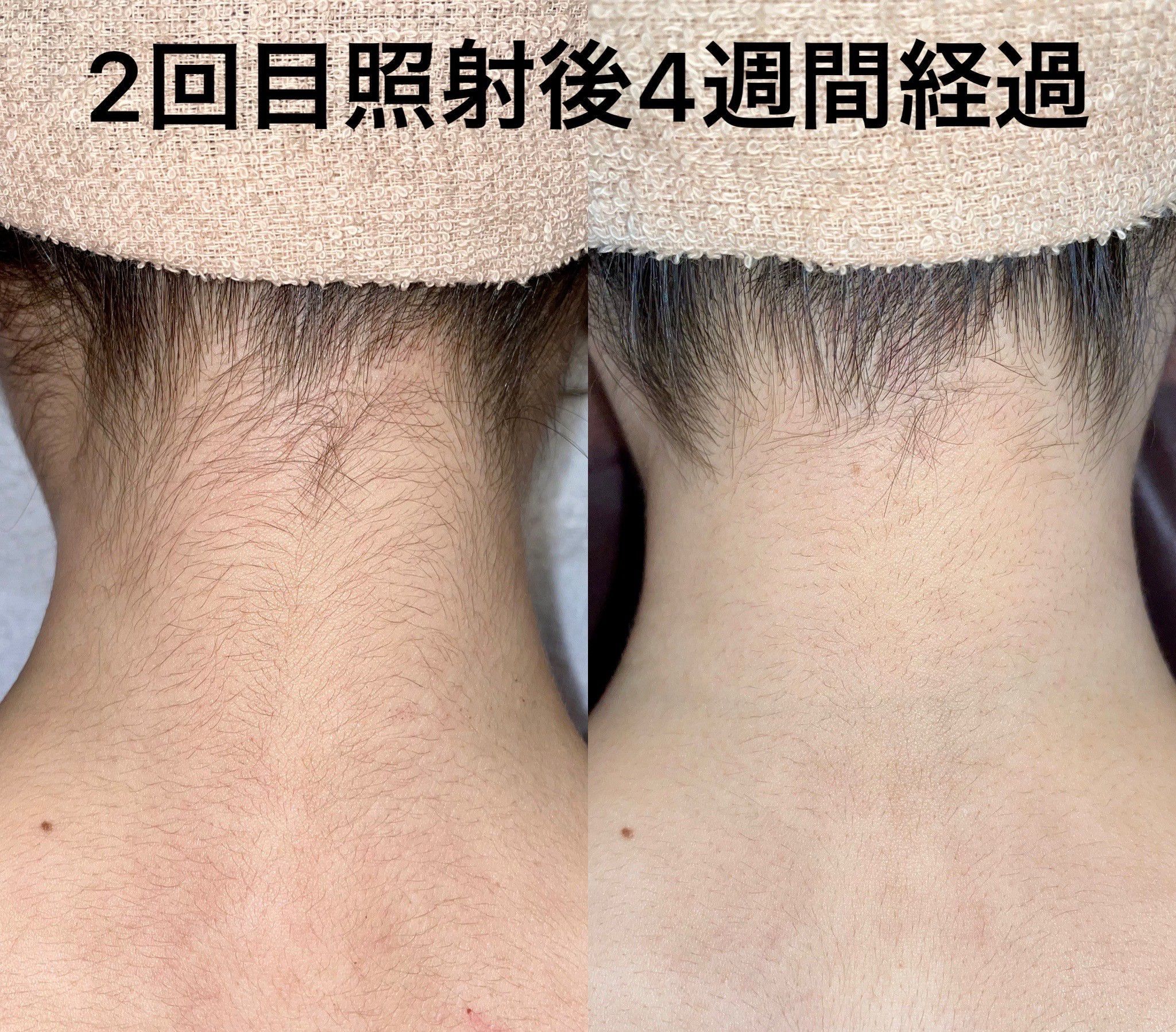 手、足、うなじ、尻、背中、胸毛、腹など、１ヶ所☆の画像