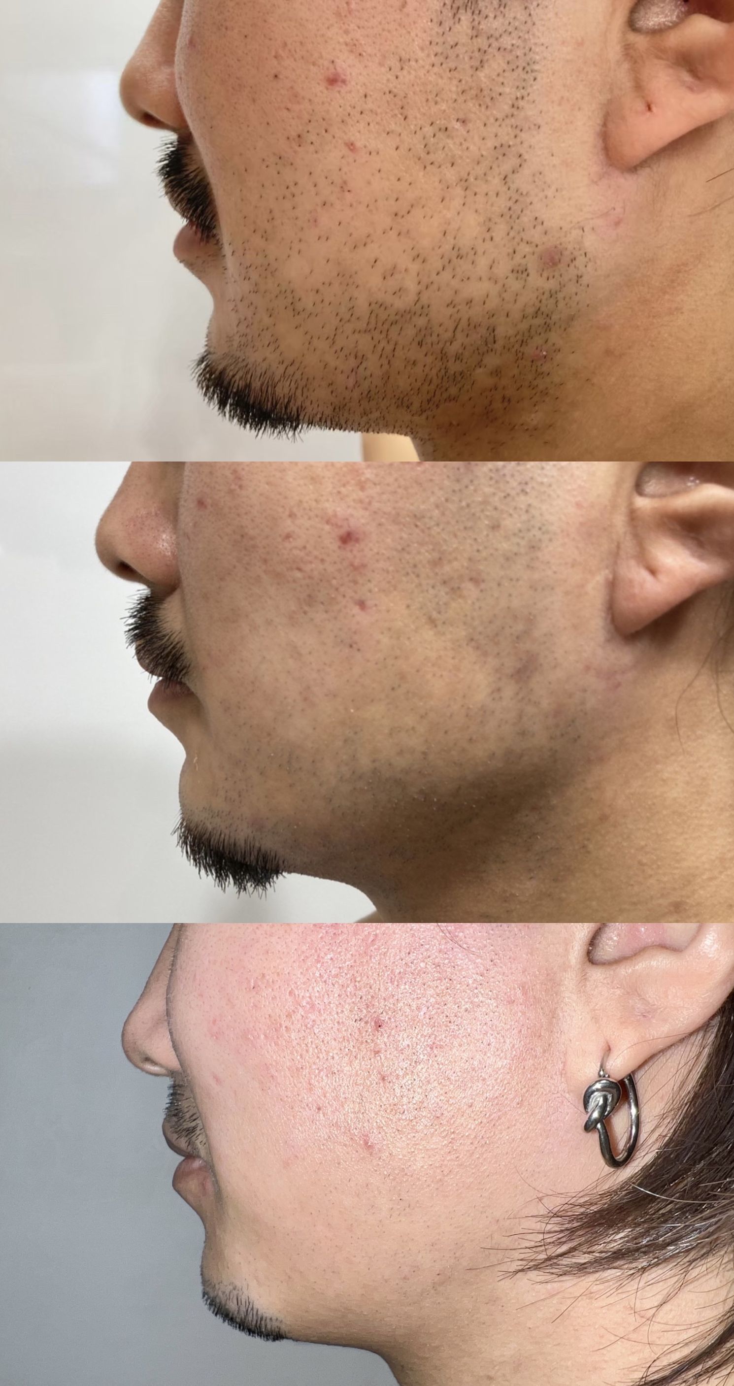 男性１番人気♪全身メンズ脱毛＆VIO＋顔含むの画像